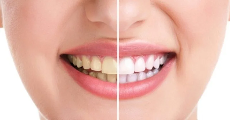 Thời gian nhận thấy răng sáng hơn phụ thuộc vào nguyên nhân đổi màu, mức độ vết ố và thói quen ăn uống của mỗi người